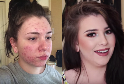 This Beauty Blogger Spent a Year Battling Severe Acne After Getting an IUD